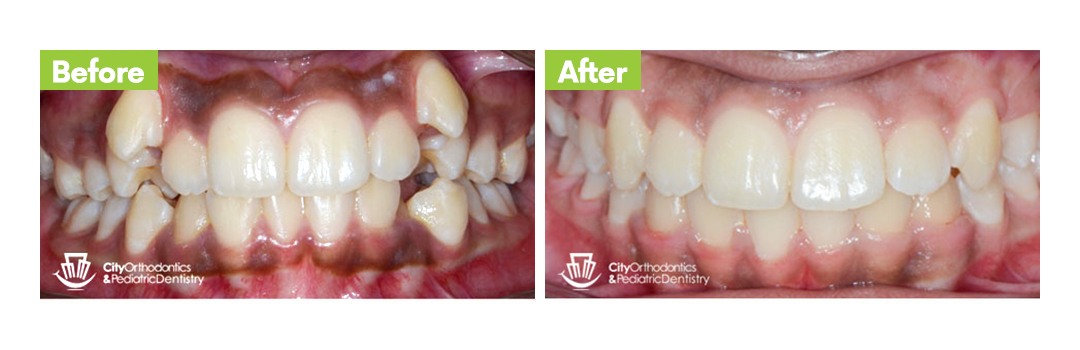 City Orthodontics & Pediatric Dentistry|Severe Crowding - Before and After