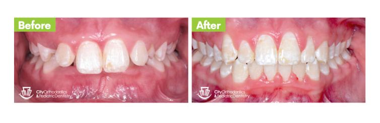 Crowding, Deep Bite, Severe Overbite – Before and After