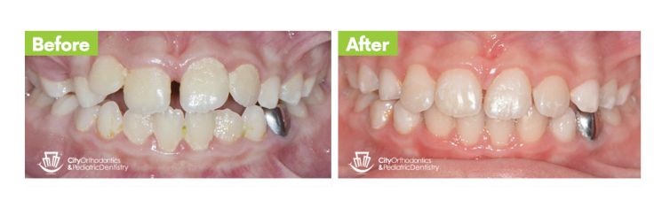 Class I with Open Bite – Before and After