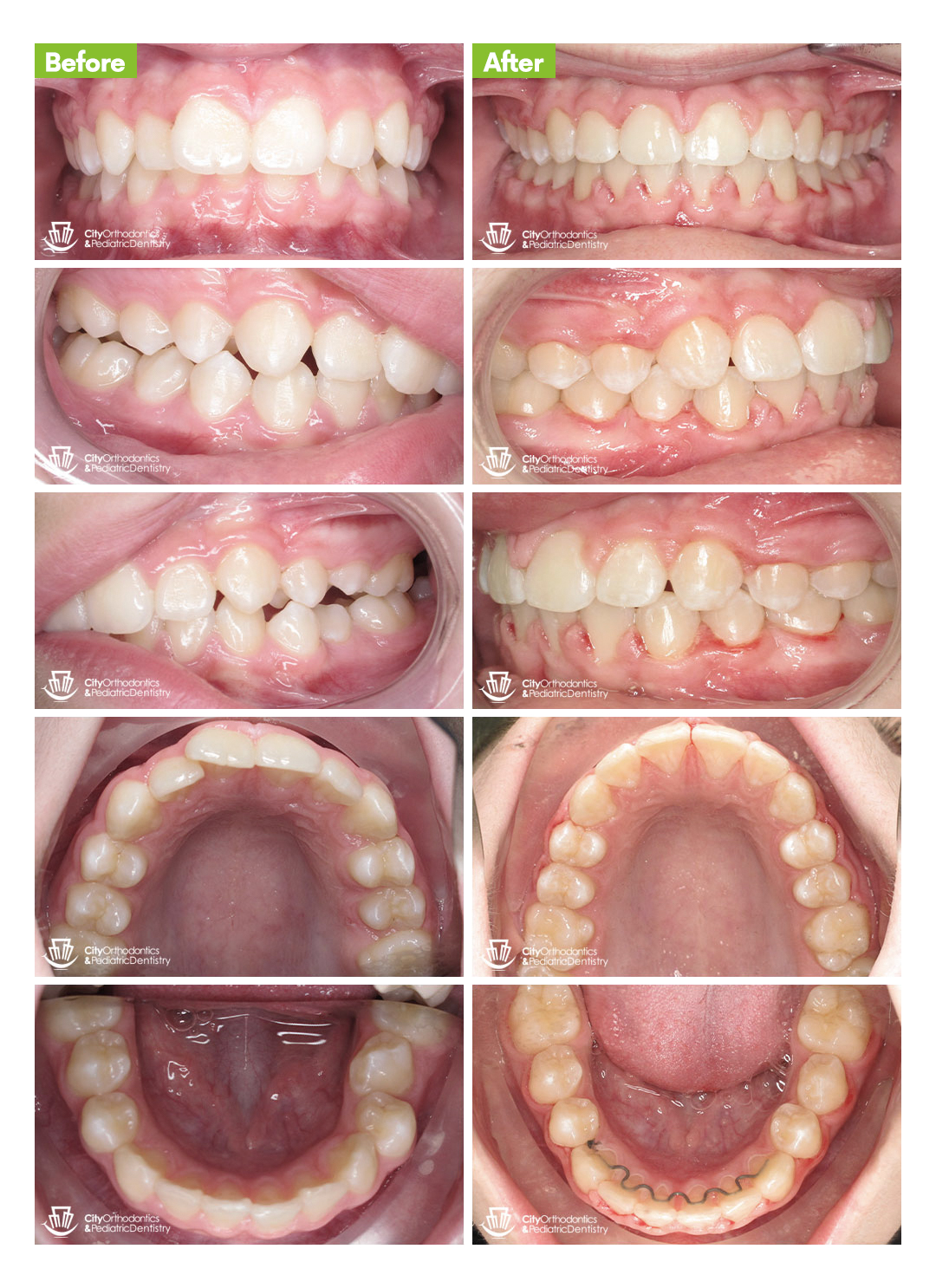 overbite before and after
