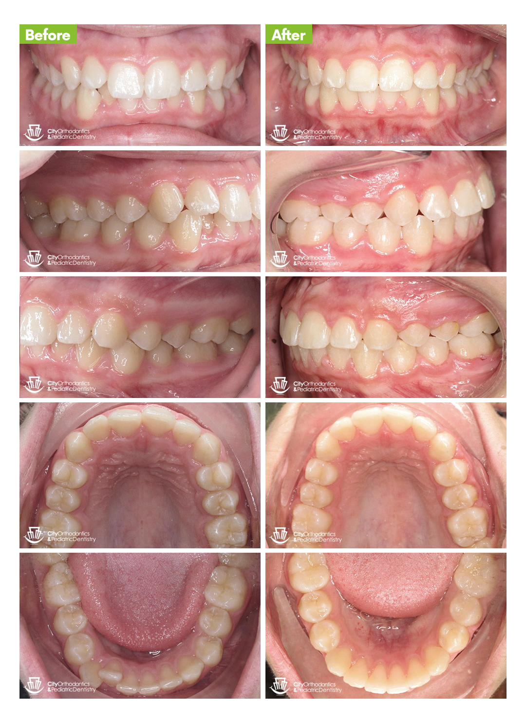 City Orthodontics & Pediatric Dentistry|Overbite (4) - Before and After