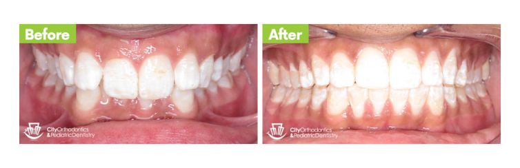 Overbite (2) – Before and After