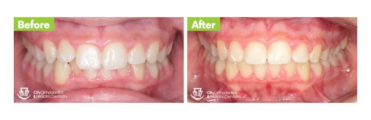 Overbite (4) – Before and After
