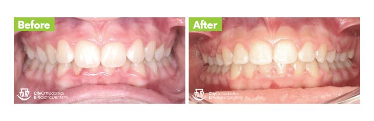 Overbite (5) – Before and After