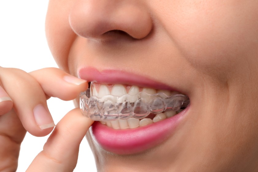 City Orthodontics & Pediatric Dentistry|Advantages of Invisalign: The Invisible Way To Straighten Teeth