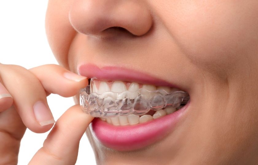 Woman,Wearing,Orthodontic,Silicone,Trainer.,Invisible,Braces