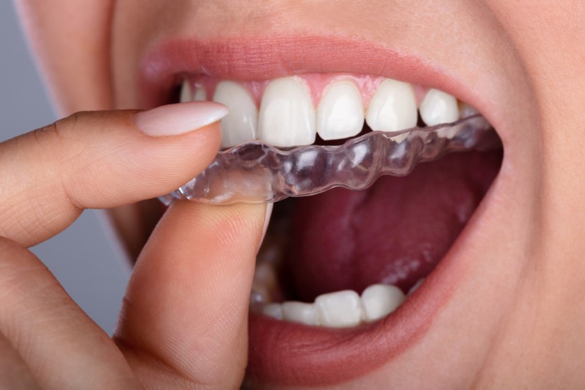 City Orthodontics & Pediatric Dentistry|4 Home Emergency Care Tips For Invisalign Aligners
