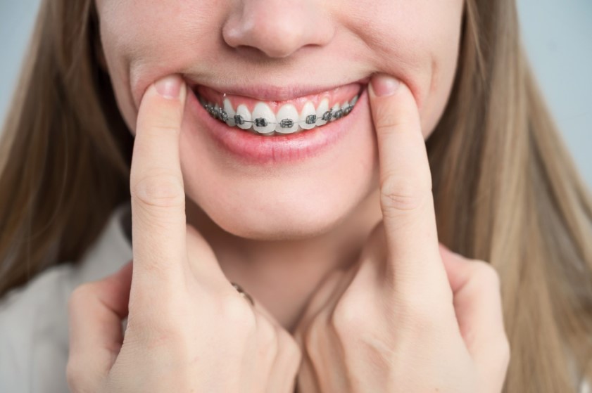 How To Treat Overbite With Invisalign 