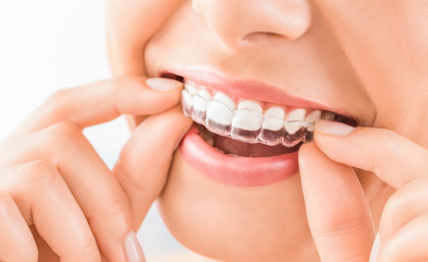 How To Treat Overbite With Invisalign 