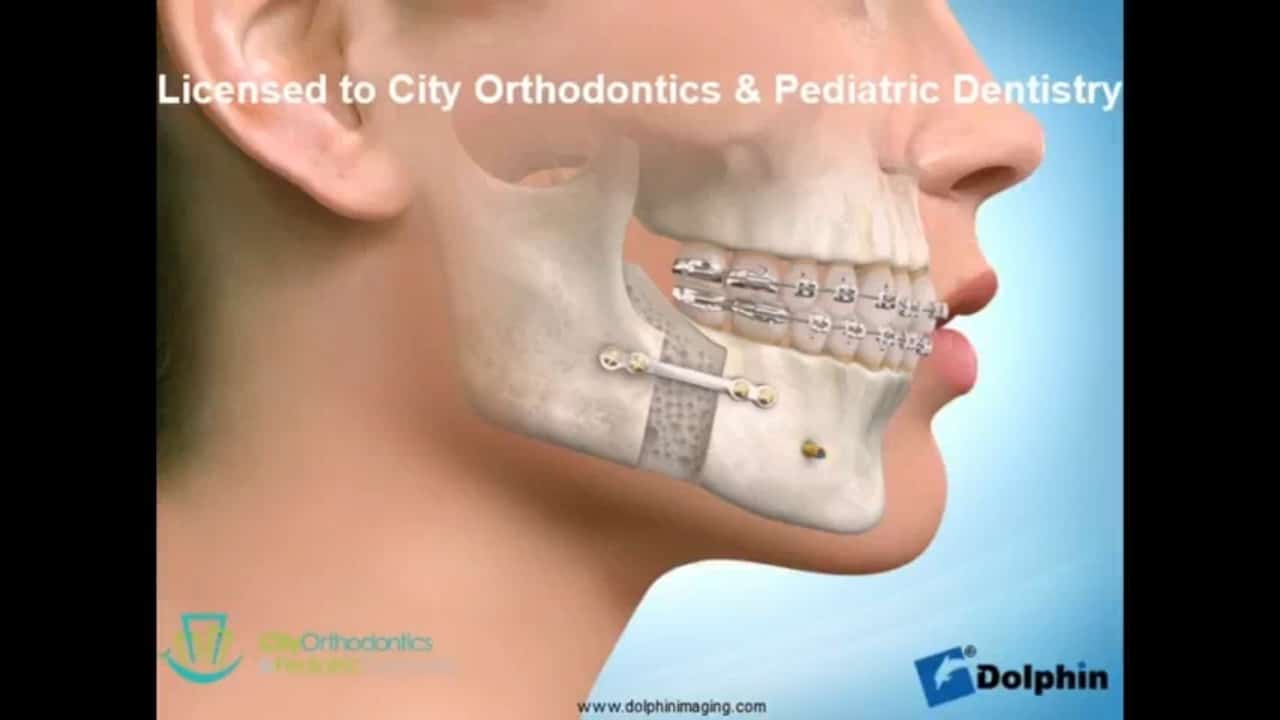 City Orthodontics & Pediatric Dentistry | Patient Educational Videos